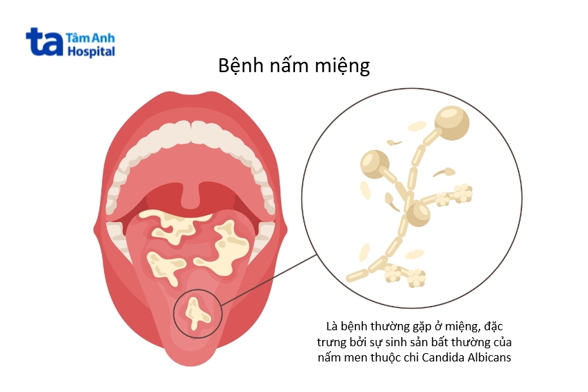 amidan có đốm hạt trắng