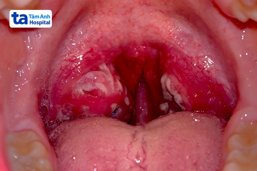 amidan mảng trắng