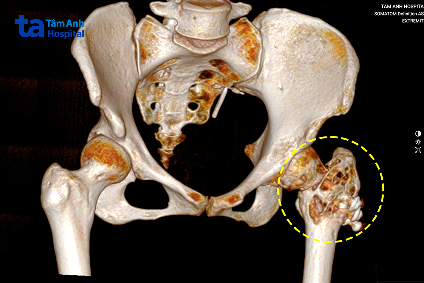ảnh chụp CT Somatom Force VB30 cho thấy chỏm đùi trái chị Lan tiêu xương nặng do u tế bào khổng lồ