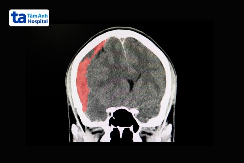 ảnh chụp máu tụ dưới màng cứng