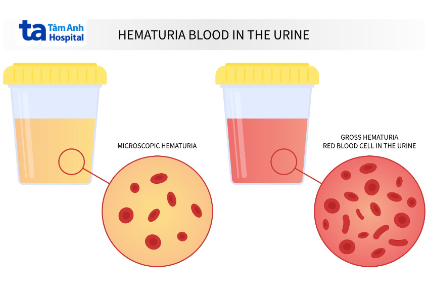 ảnh minh họa hai dạng hồng cầu trong nước tiểu