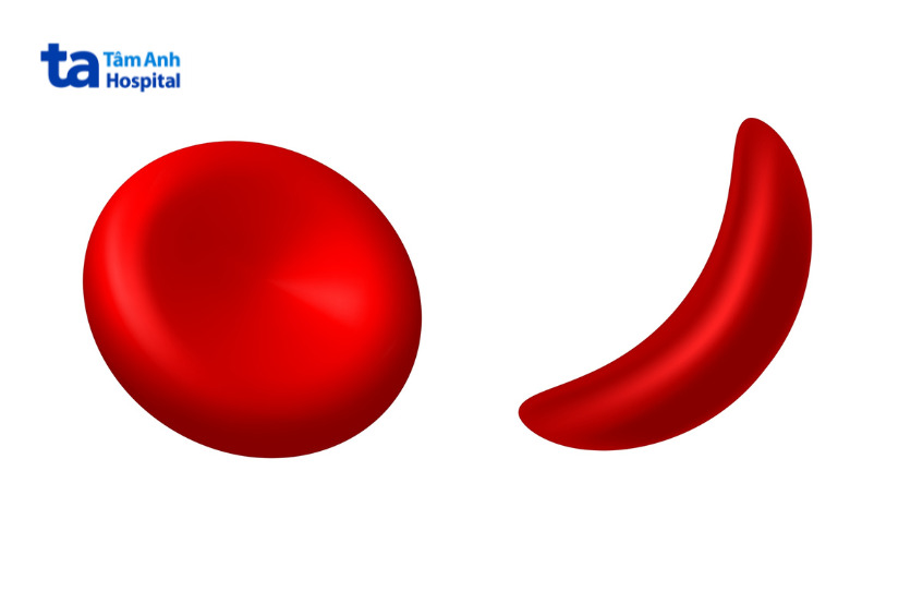 ảnh minh họa hồng cầu hình liềm