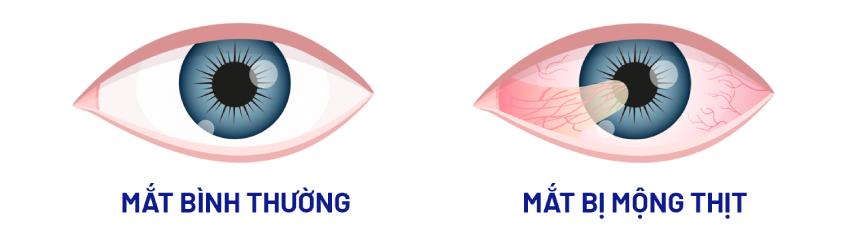 ảnh minh họa sự khác biệt giữa mắt bình thường (trái) và mắt bị mộng thịt. nguồn ảnh_ visionary eye doctor.