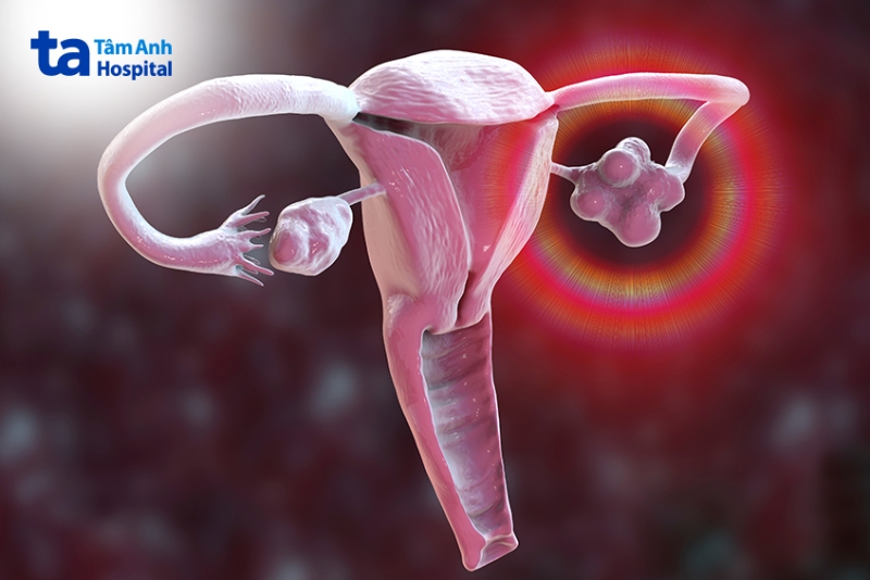 ảnh minh họa u nang buồng trứng trái