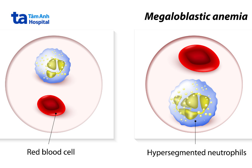 ảnh so sánh máu bình thường và thiếu máu hồng cầu khổng lồ