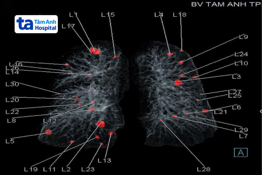 áp dụng ai trong chụp ct phổi