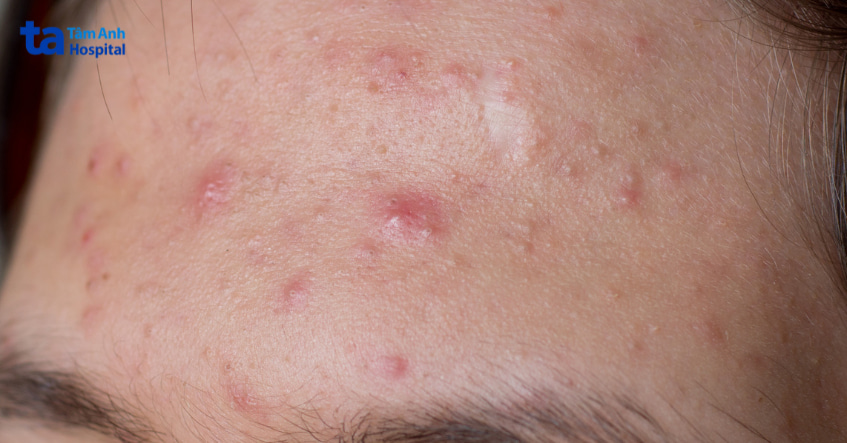 Hình ảnh cận cảnh vùng trán bị mụn viêm và mụn ẩn, tình trạng da thường được chỉ định điều trị bằng azelaic acid