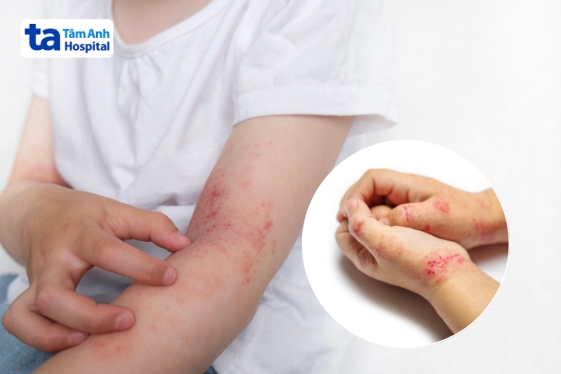 ban đỏ xuất hiện ở nếp gấp cổ tay