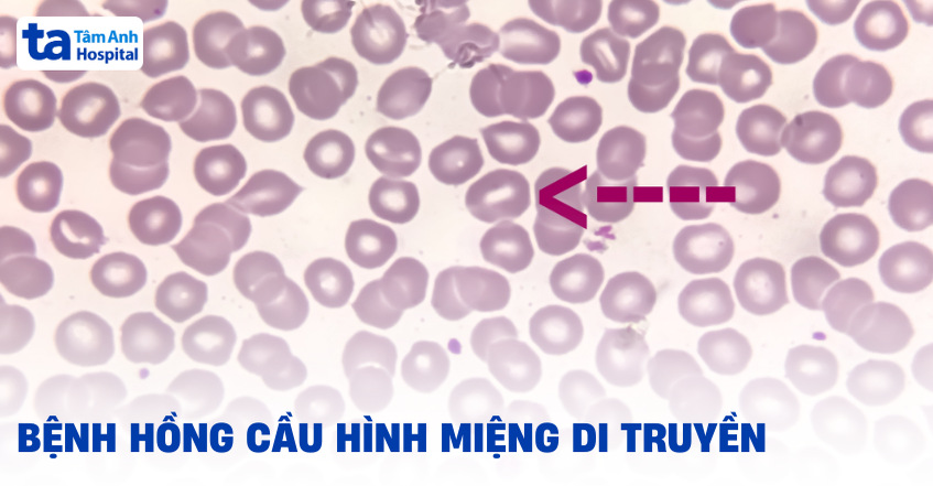 Bệnh hồng cầu hình miệng di truyền: Thông tin cần biết