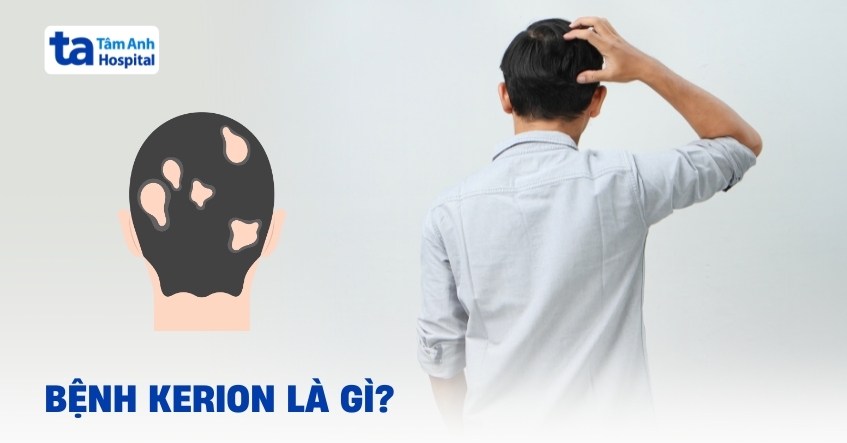 Bệnh Kerion: Một dạng tình trạng da đầu