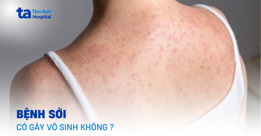 Giải đáp: Bệnh sởi có gây vô sinh không?