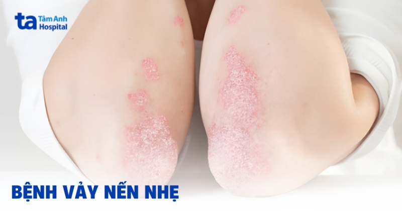 Giải pháp cho bệnh vảy nến nhẹ nào phù hợp?