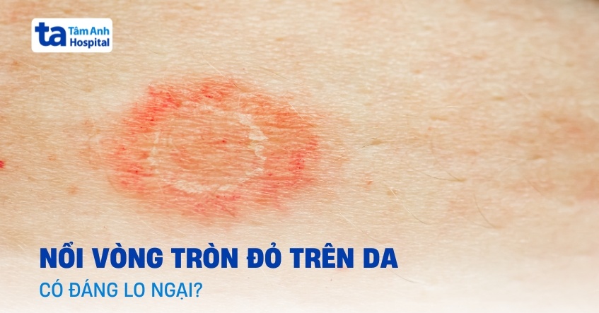 Bị nổi vòng tròn đỏ trên da và ngứa có phải bệnh lý?
