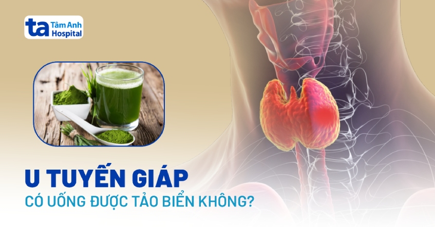 Bị u tuyến giáp có uống được tảo biển không? Cần lưu ý điều gì?
