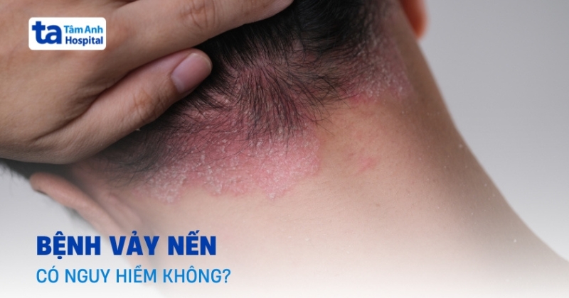 Các biến chứng bệnh vảy nến nguy hiểm và phổ biến