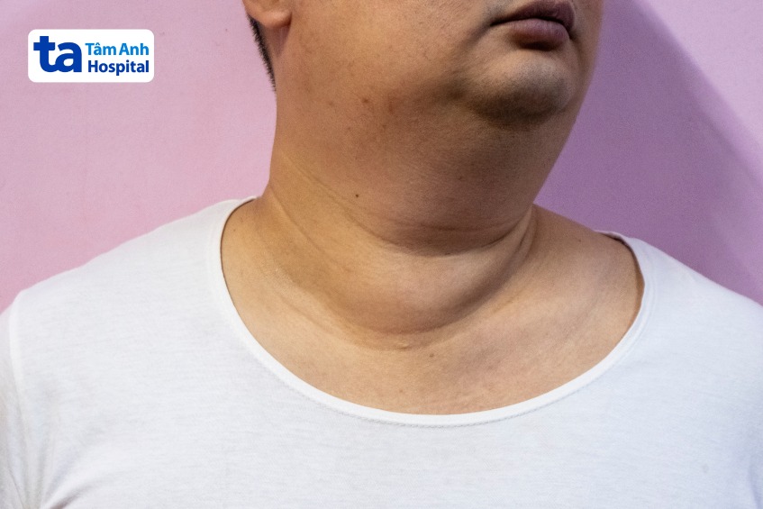 Biến chứng quai bị là nguyên nhân lớn dẫn đến vô sinh ở nam giới