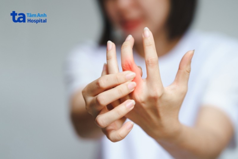 viêm khớp do vảy nến