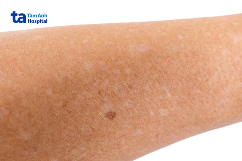 biểu hiện lâm sàng bệnh giảm sắc tố dạng giọt tự phát