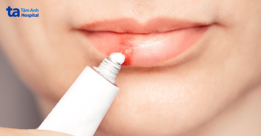 Bôi kem Acyclovir lên môi bị mụn rộp do virus herpes simplex gây ra