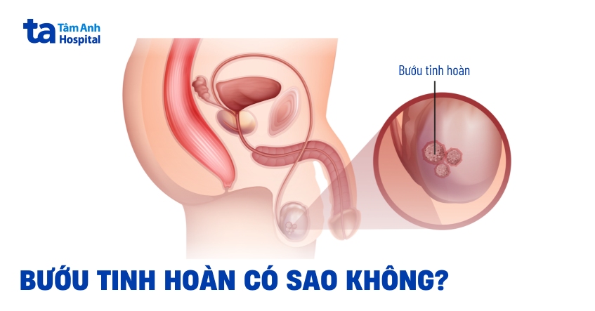 Cần biết gì về bướu tinh hoàn ở nam giới?