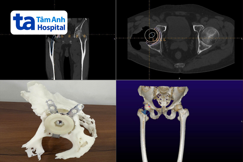 các công nghệ 3d được sử dụng trong ca mổ của ông frederik