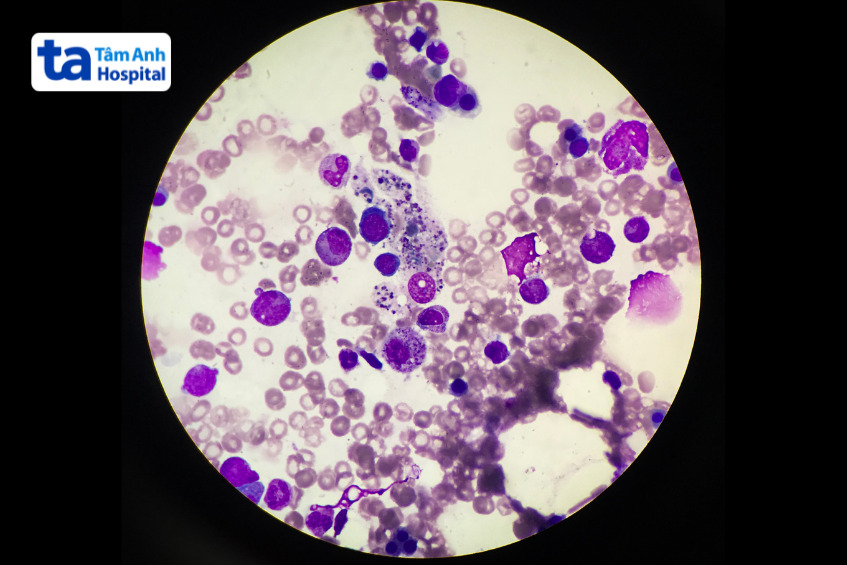 các đại thực bào đang thực bào hồng cầu