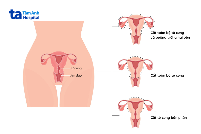 Minh họa các dạng phẫu thuật cắt tử cung toàn phần, bán phần và kèm buồng trứng