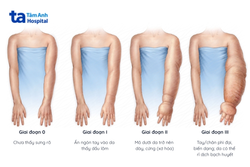 Các giai đoạn của bệnh phù bạch huyết