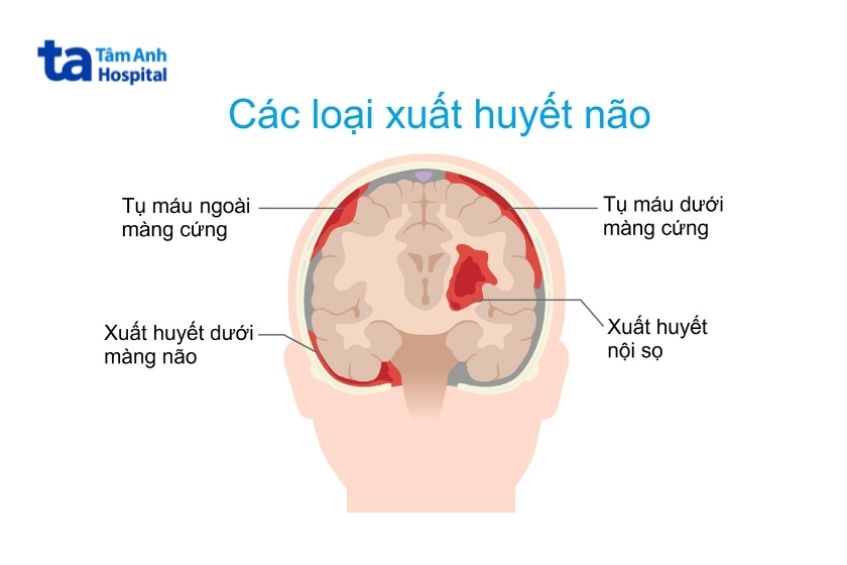 các loại xuất huyết não
