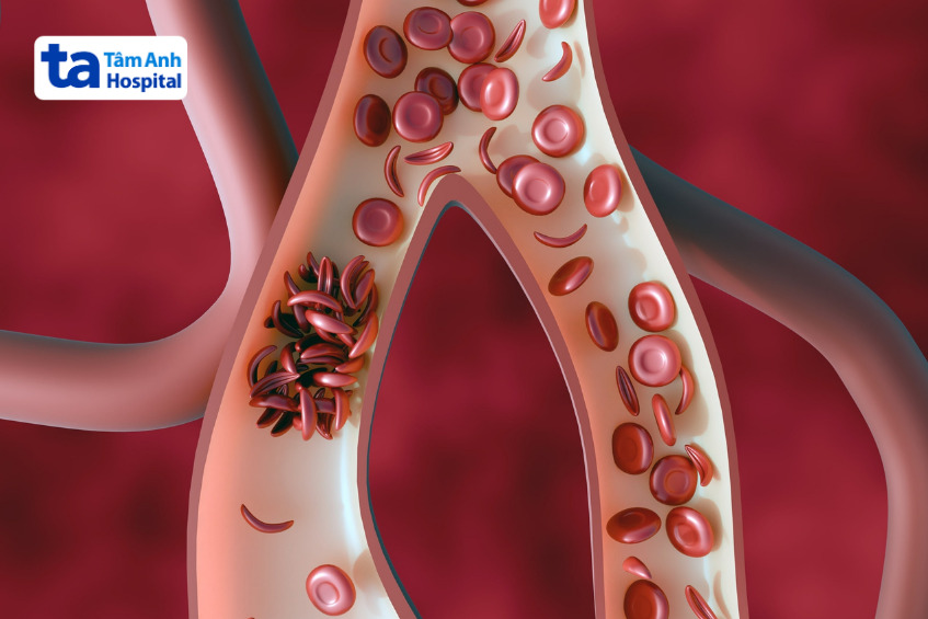 các tế bào hồng cầu hình liềm gây tắc lưu lượng máu