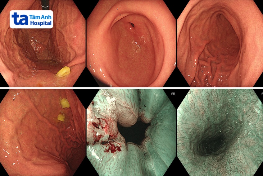các vết loét đã chảy máu xuất hiện trong tá tràng bé hưng