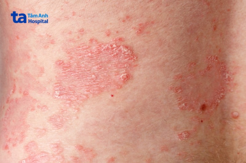 cận cảnh vảy nến trên da mũi