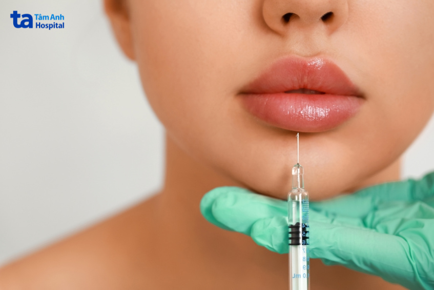 cần kiêng hôn bao lâu sau tiêm filler môi