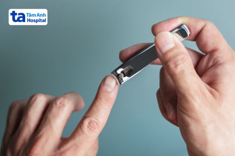 cắt móng tay ngừa vảy nến móng