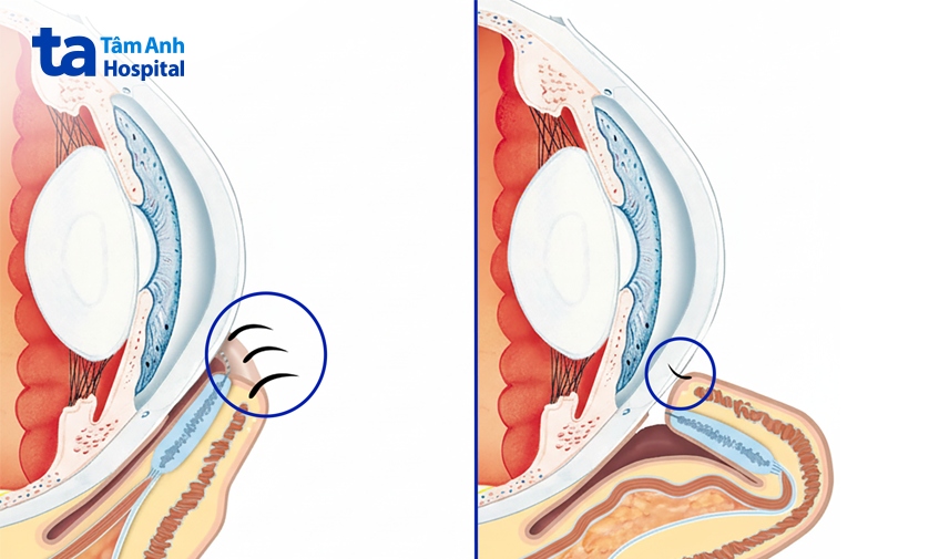 cấu tạo mắt bình thường (trái) và mắt có bị mi dưới quặm vào trong. ảnh minh họa_ tidsskriftet