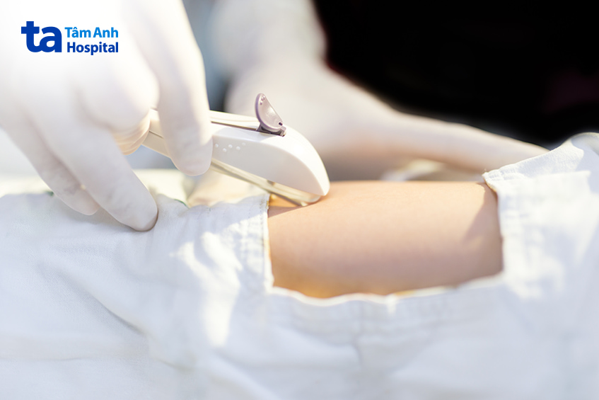 Thiết bị cấy que tránh thai được sử dụng trên cánh tay bệnh nhân nữ