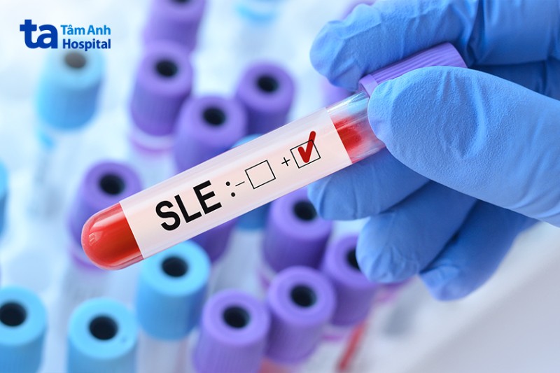 xét nghiệm máu chẩn đoán lupus