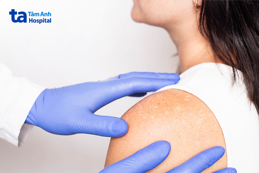 chẩn đoán nguyên nhân mất sắc tố da