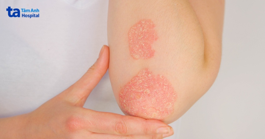 chẩn đoán phân biệt viêm da atopy