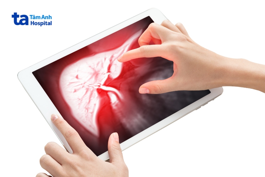 chẩn đoán phình động mạch gan