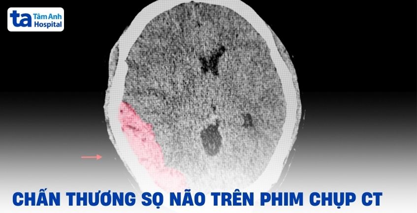 Hình ảnh chấn thương sọ não trên phim chụp CT ra sao?