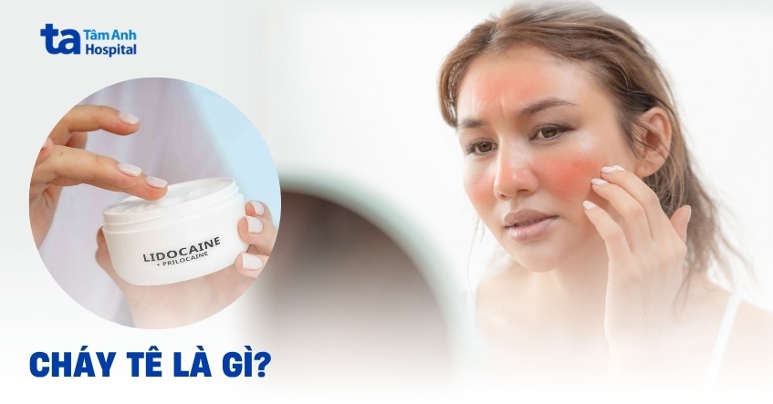 Cháy tê là gì? Nguyên nhân, dấu hiệu và cách phòng tránh