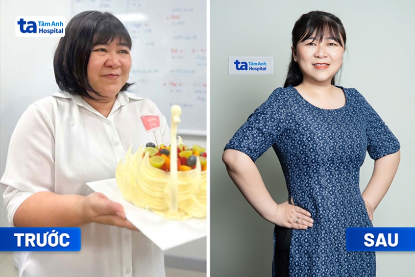 chị lương thị loan thanh (45 tuổi, tp.hcm) giảm 17kg sau 6 tháng điều trị, lần đầu giảm cân thành công, tự tin hơn
