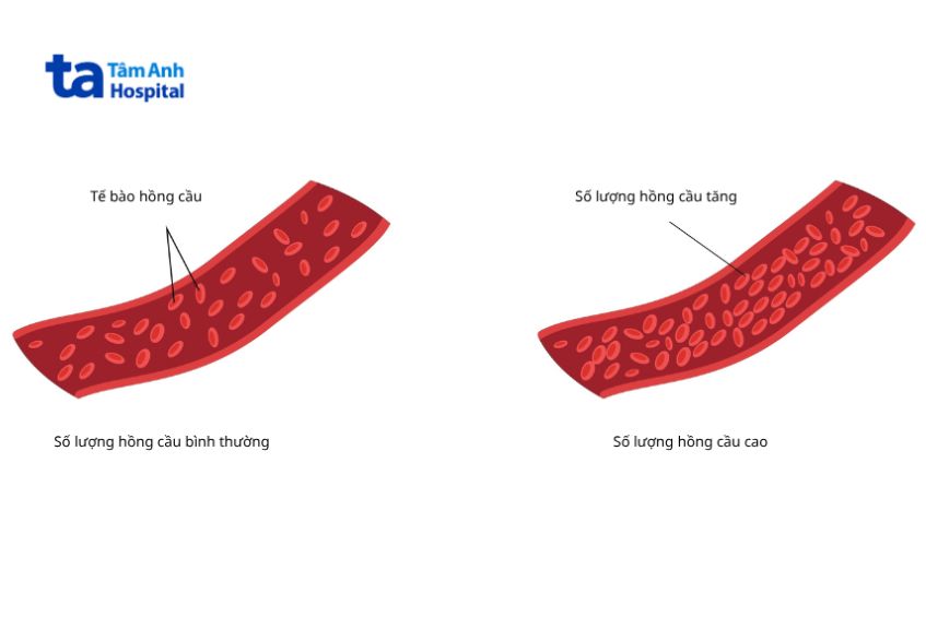 chỉ số số lượng hồng cầu cao có thể là dấu hiệu cảnh báo một số bệnh lý