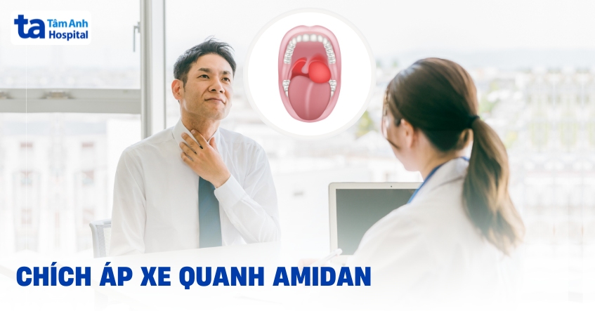 Quy trình chích áp xe quanh amidan diễn ra như thế nào?