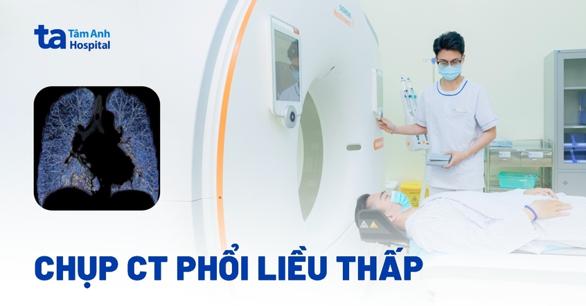 Kỹ thuật chụp CT phổi liều thấp có vai trò và ưu điểm gì?
