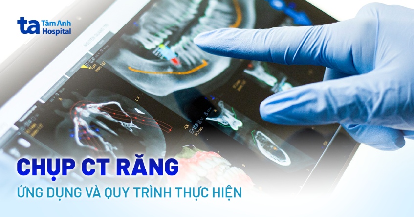 Chụp CT răng ứng dụng trong nha khoa: Quy trình thực hiện