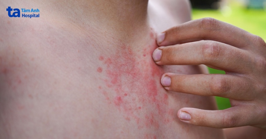 cơn ngứa dữ dội vì viêm da tiếp xúc