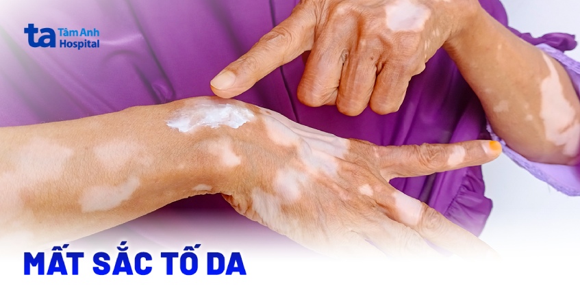 Da bị mất sắc tố cần khắc phục thế nào?