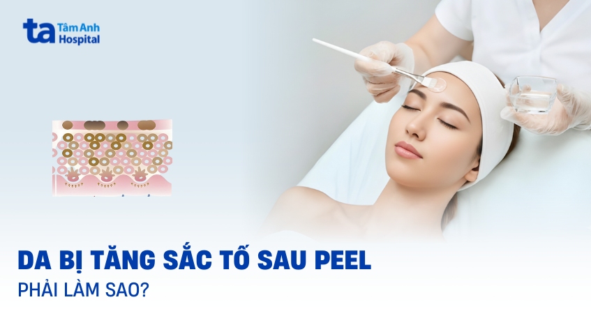 Da bị tăng sắc tố sau peel: Nguyên nhân và cách cải thiện